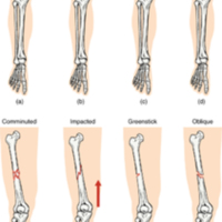Types of Fractures 