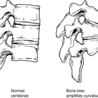 Osteoporosis.jpg