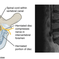 Herniated Intervertebral Disc